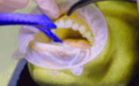 【薦】拔牙記作文